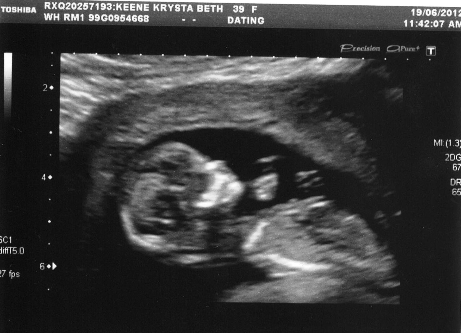 12 Weeks Pregnant Scan