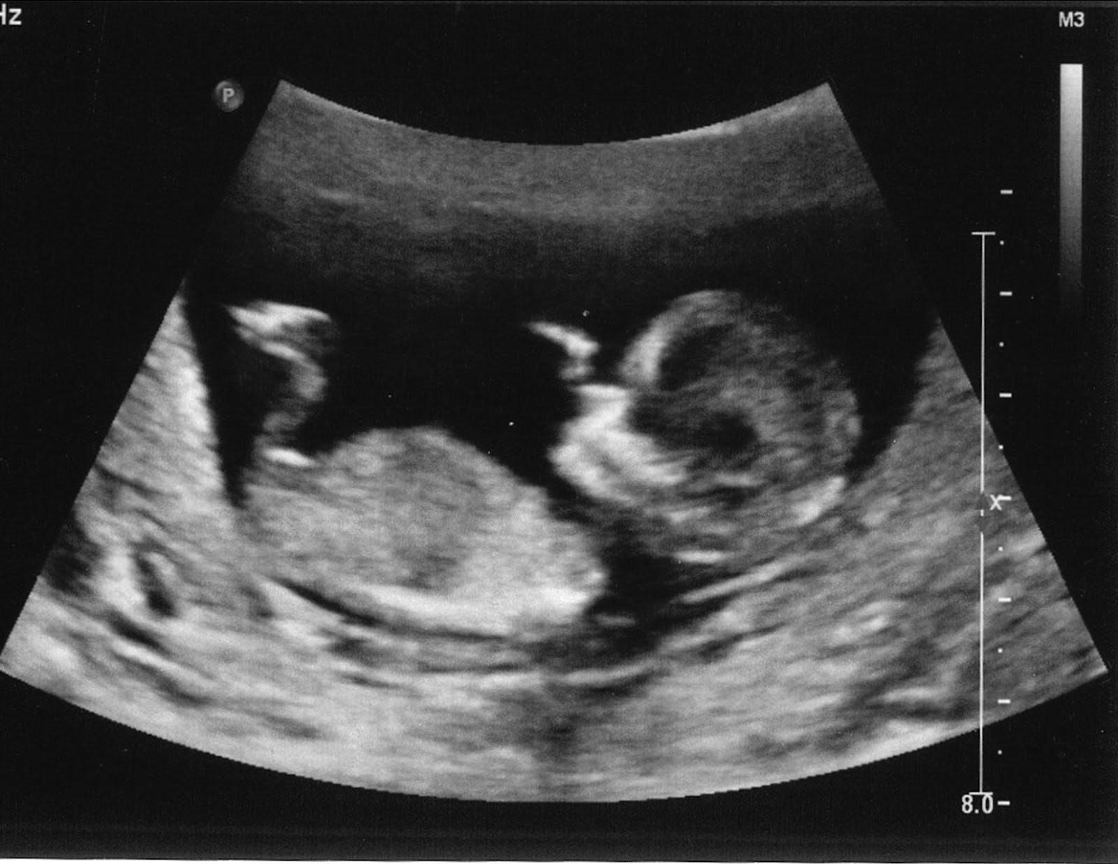 12 Weeks Pregnant Ultrasound Boy Or Girl