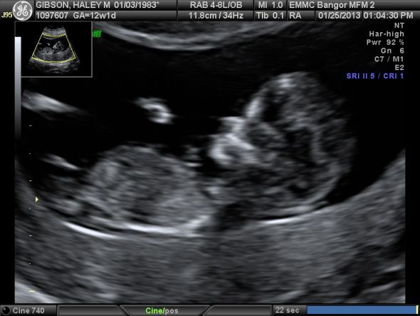 12 Weeks Pregnant Ultrasound Boy Or Girl