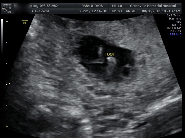 12 Weeks Pregnant Ultrasound Boy Or Girl