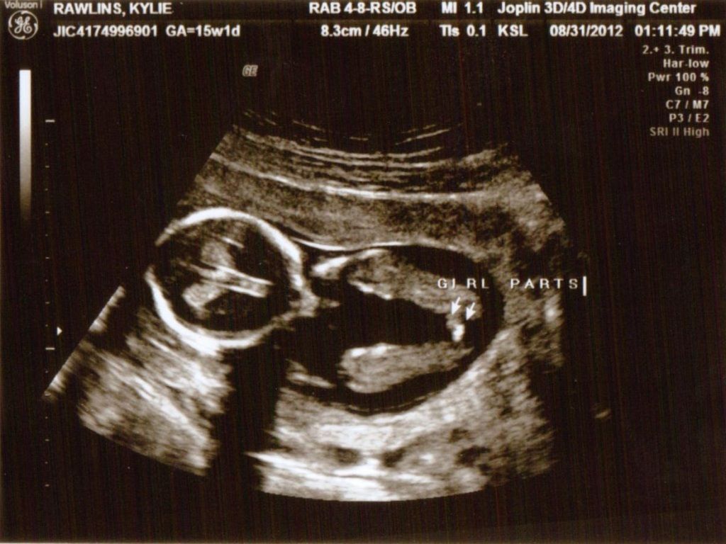 12 Weeks Pregnant Ultrasound Boy Or Girl