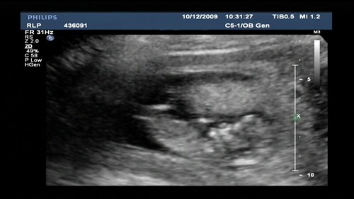 12 Weeks Pregnant Ultrasound Gender
