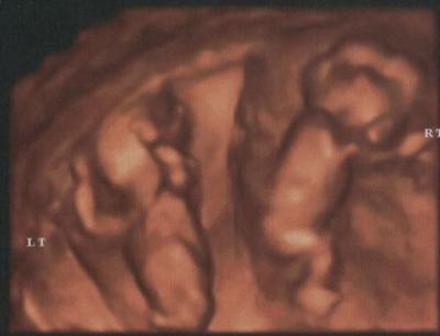 12 Weeks Pregnant Ultrasound Gender