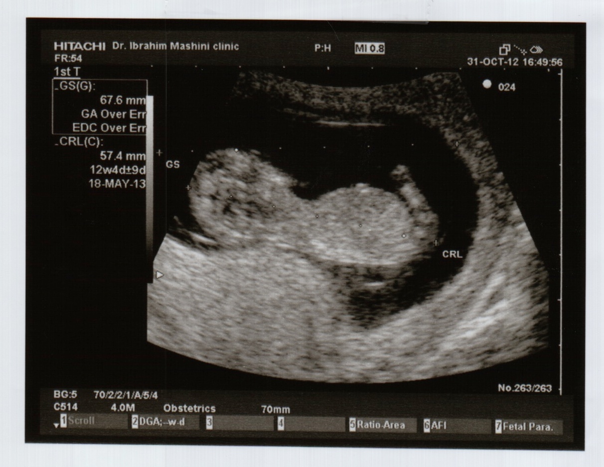 12 Weeks Pregnant Ultrasound Pictures