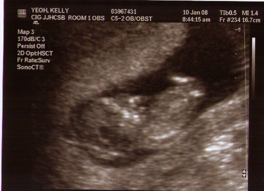 12 Weeks Pregnant Ultrasound Pictures