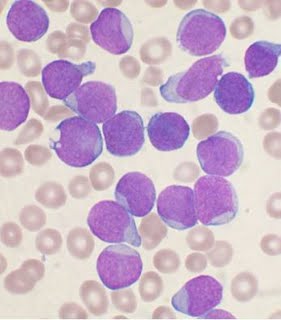 Children With Leukemia Survival Rate