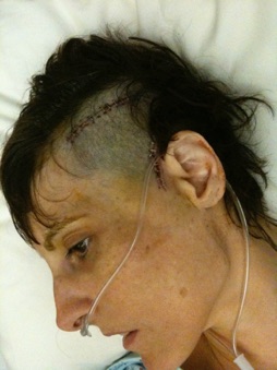 After Brain Tumor Surgery