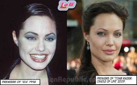 Angelina Jolie Lips Before Surgery