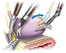 Appendix Operation Cost In Kolkata