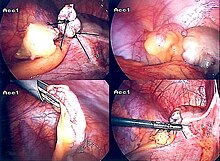 Appendix Removal Procedure