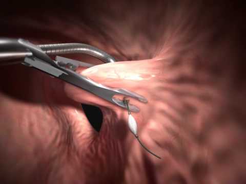 Appendix Removal Procedure