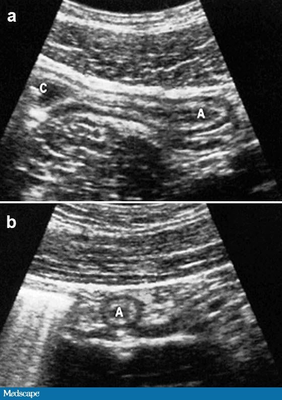Appendix Removal Procedure