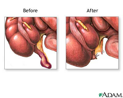 Appendix Removal Procedure