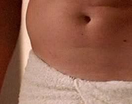 Appendix Scar On Left Side