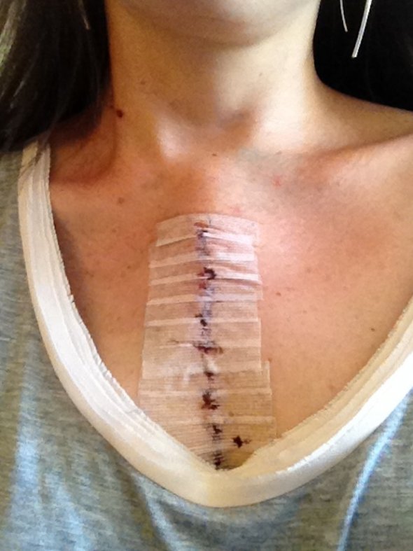 Appendix Scar On Left Side