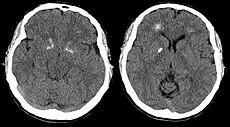 Autosomal Dominant Disorders Mnemonic