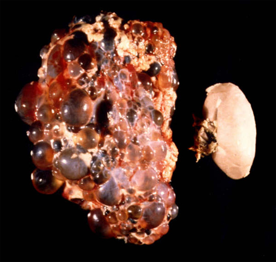 Autosomal Dominant Polycystic Kidney Disease Symptoms