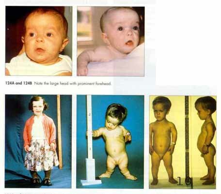 Autosomal Recessive Inheritance Lactose Metabolism Is Blocked