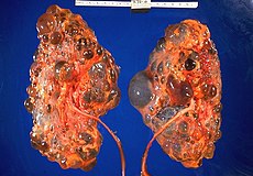 Autosomal Recessive Polycystic Kidney Disease Histology