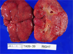Autosomal Recessive Polycystic Kidney Disease Histology