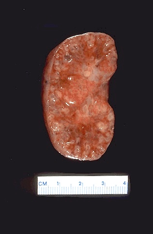 Autosomal Recessive Polycystic Kidney Disease In Fetus