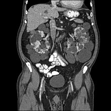Autosomal Recessive Polycystic Kidney Disease In Fetus