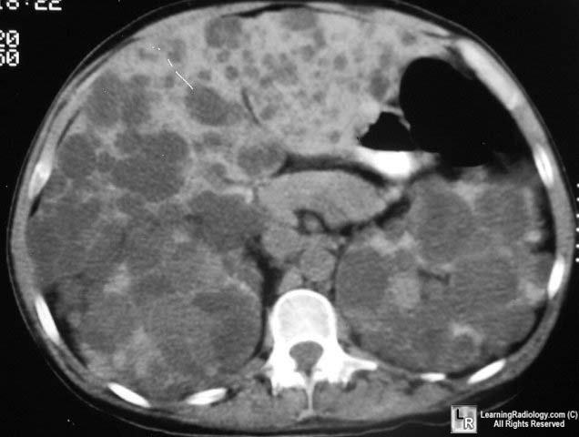Autosomal Recessive Polycystic Kidney Disease Radiology