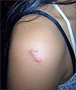 Bcg Vaccine Scar Infection
