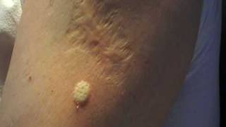 Bcg Vaccine Scar Infection
