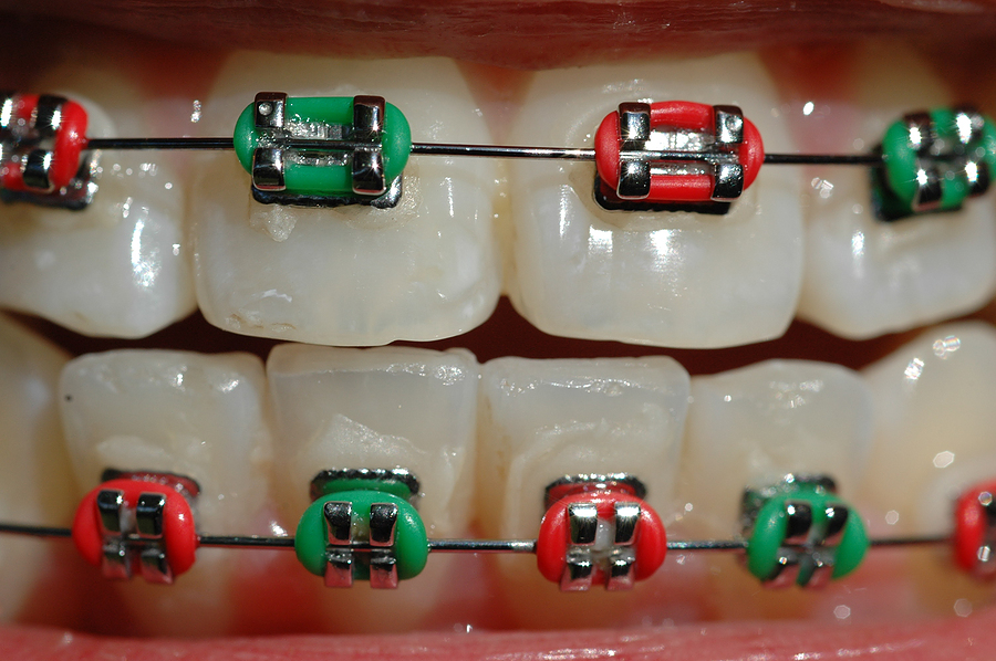 Braces Colours For Boys