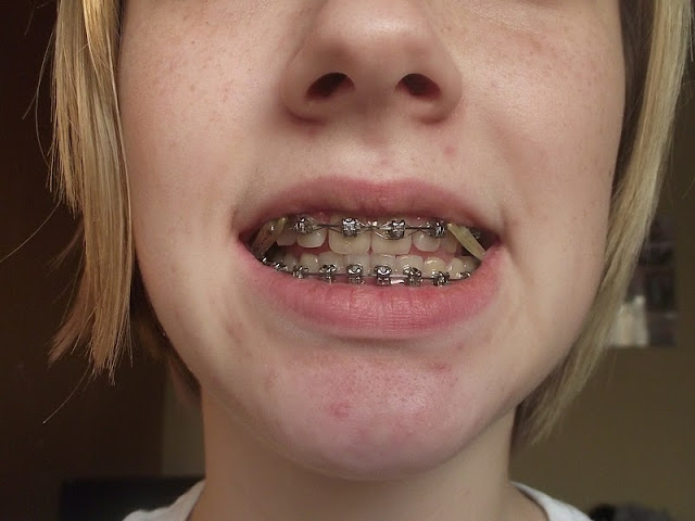 Braces Colours Nhs