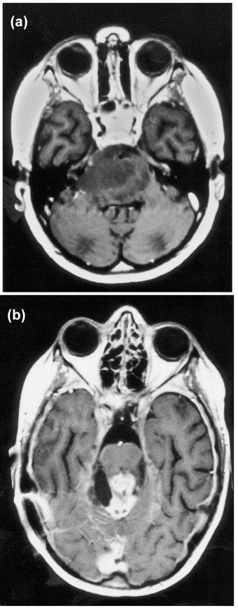 Brain Stem Glioma Survivors