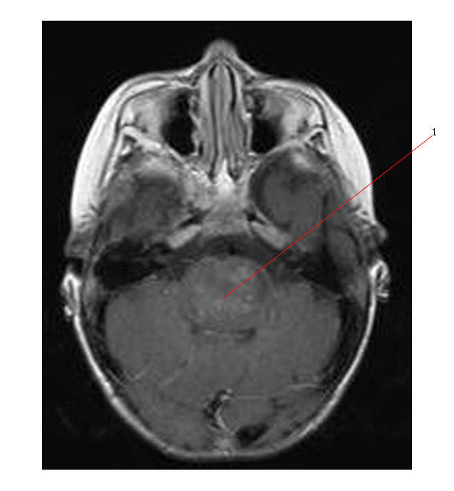 Brain Stem Glioma Treatment