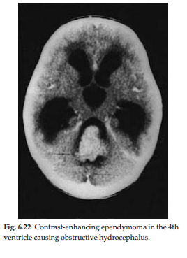 Brain Stem Glioma Treatment