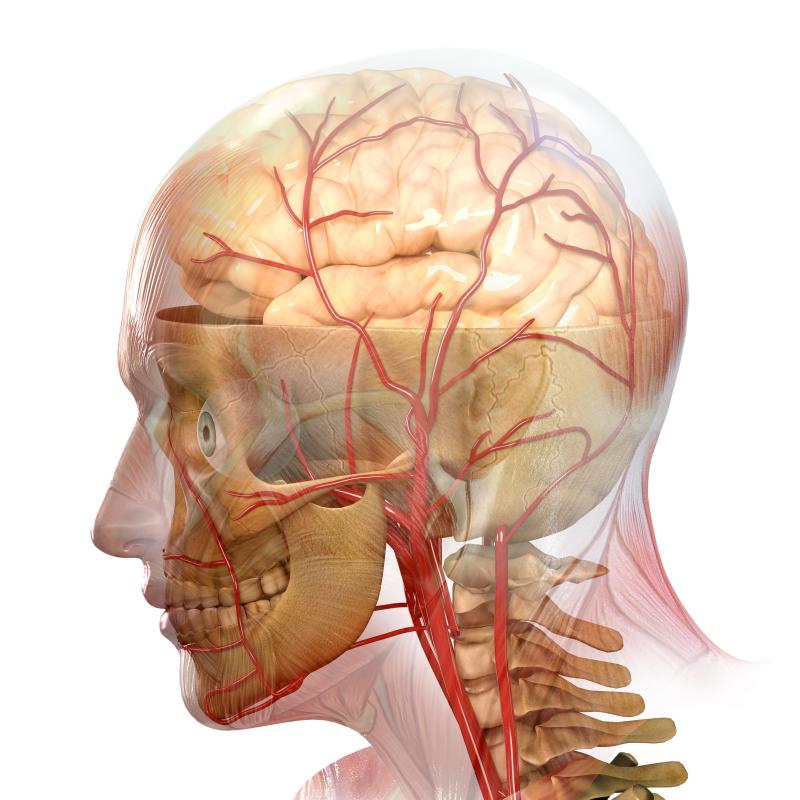 Brain Tumor Causes Stroke