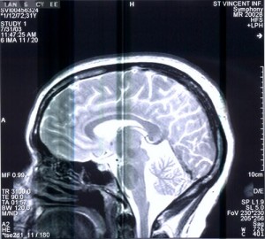 Brain Tumor Causes Stroke