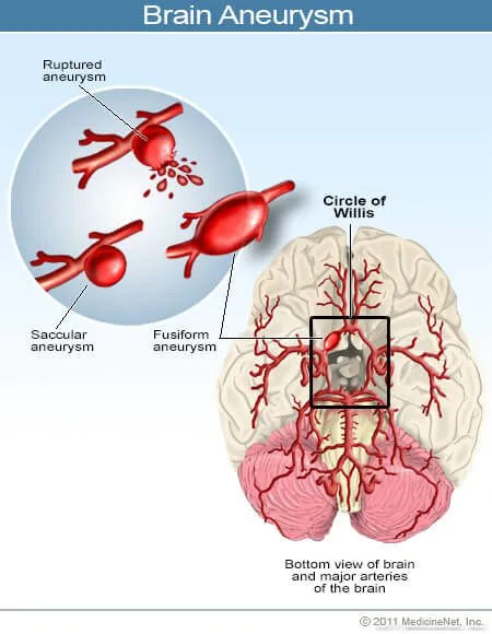 Brain Tumor Causes Stroke
