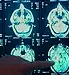 Brain Tumor Causes Stroke