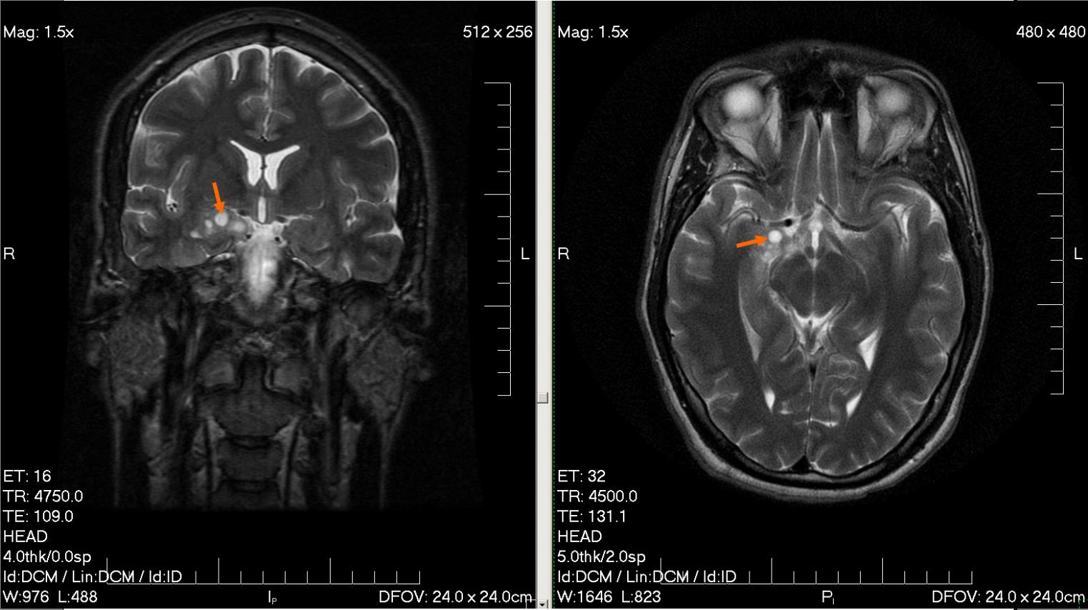 Brain Tumor Mri Images