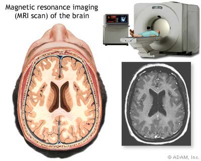 Brain Tumor Surgery Procedure