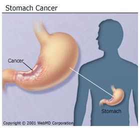 Brain Tumor Symptoms Webmd