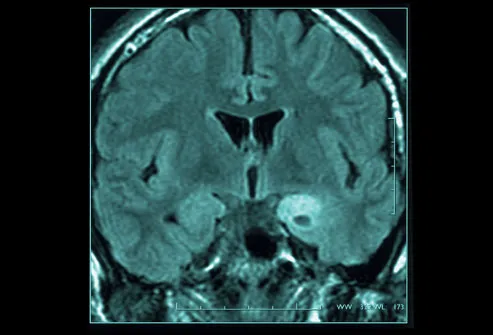 Brain Tumor Symptoms Webmd