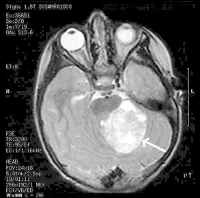 Brain Tumor Symptoms Webmd