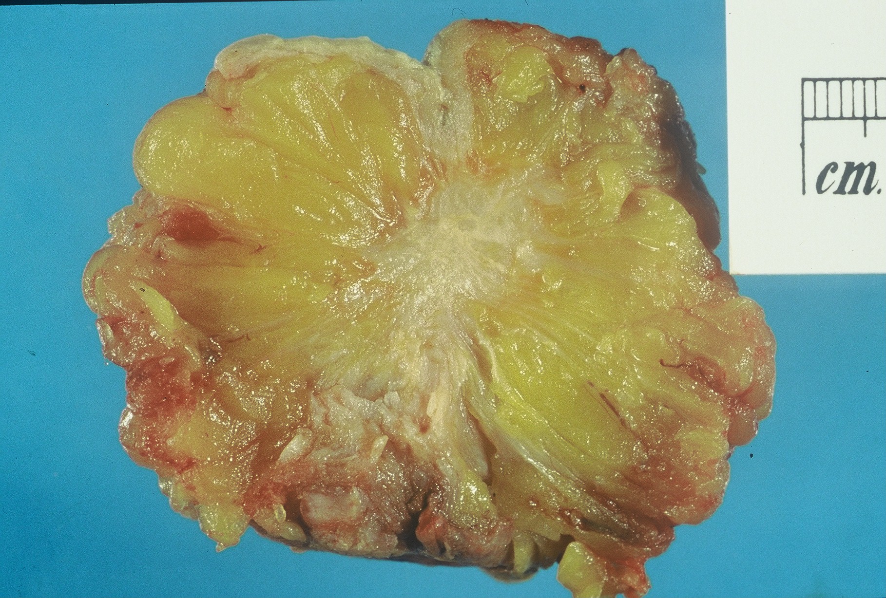 Breast Cancer