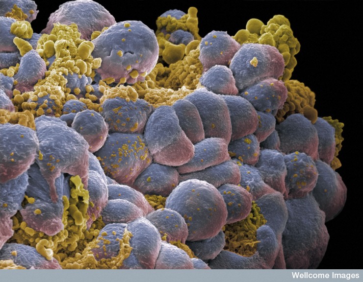 Breast Cancer Cells Dividing