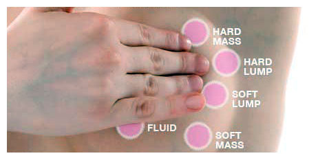 Breast Cancer Lump Size