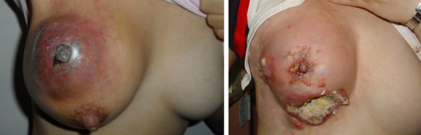 Breast Cancer Lump Size