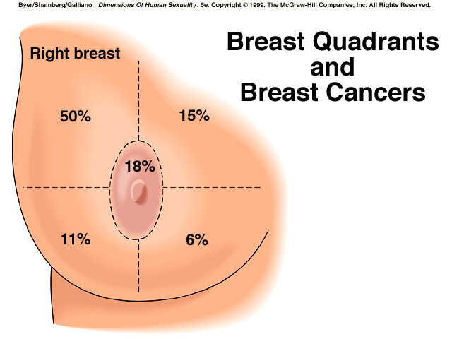 Breast Cancer Lump Size