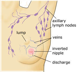 Breast Cancer Lump Size