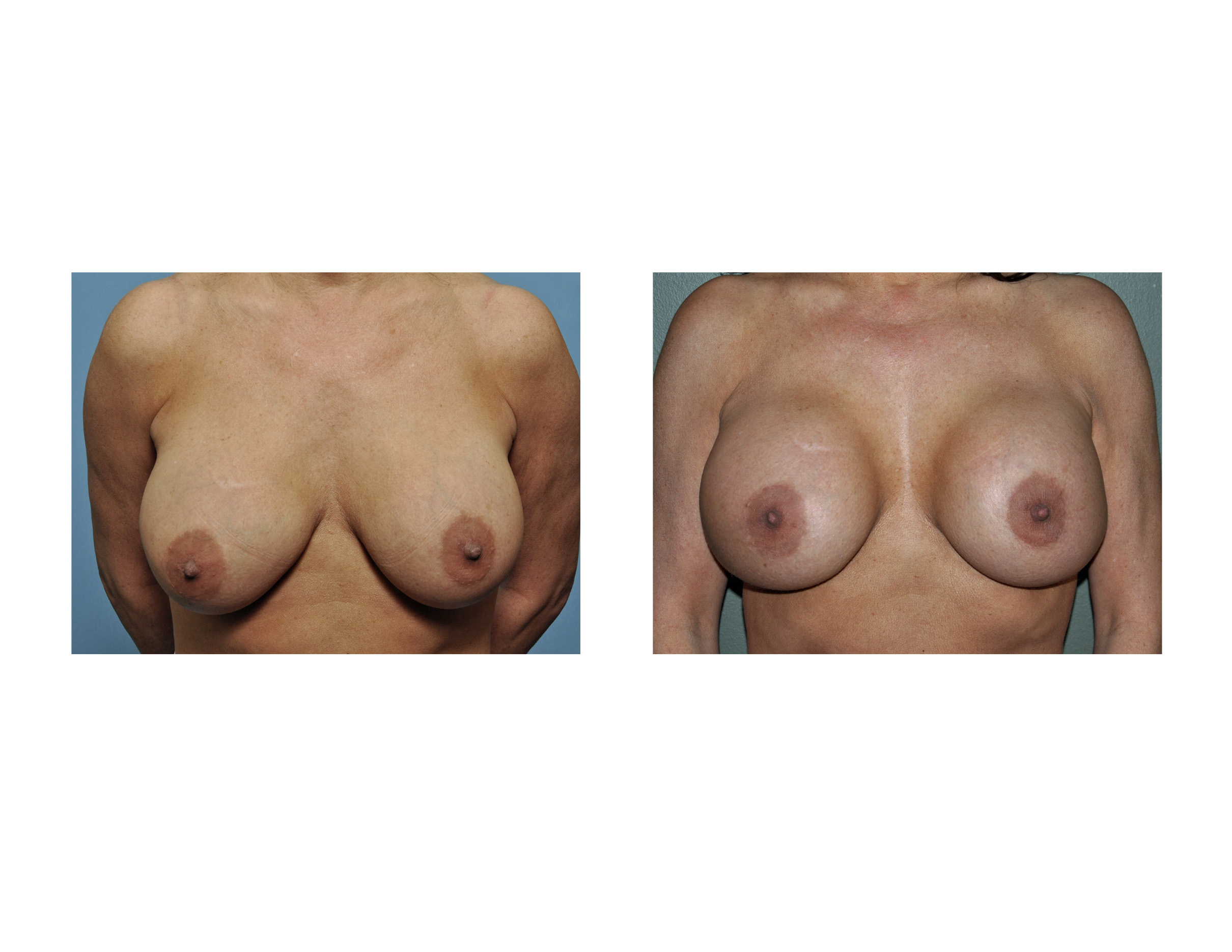 Breast Implants